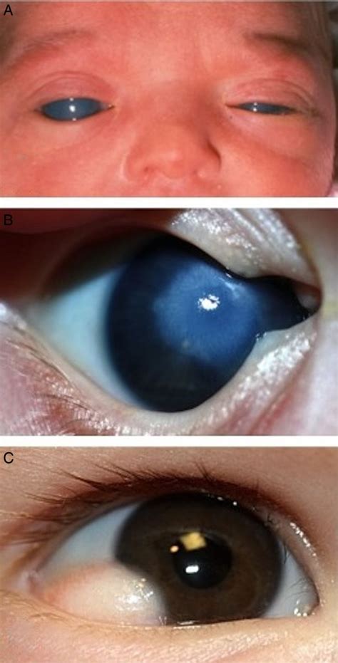 Newborn Eye Defects: Spotting & Solutions