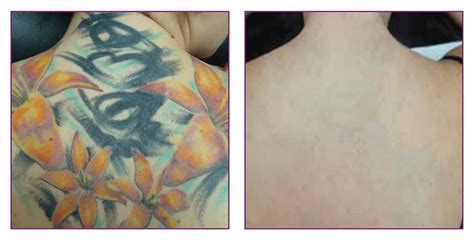 Tattoo Removal in the North East Tattoo Removal