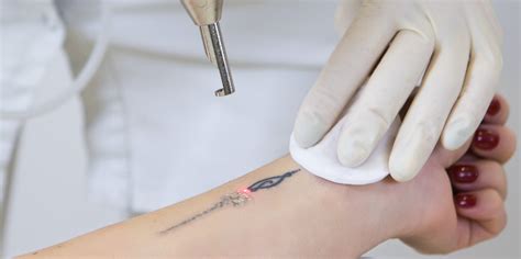 New tattoo removal technologies Think Before You Get