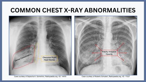 Next Steps After an Abnormal Chest X-Ray