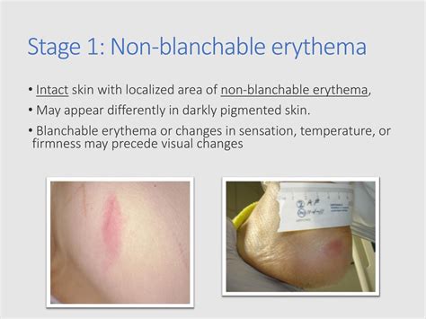 Understanding Non-Blanchable Erythema in Intact Skin: Key Insights