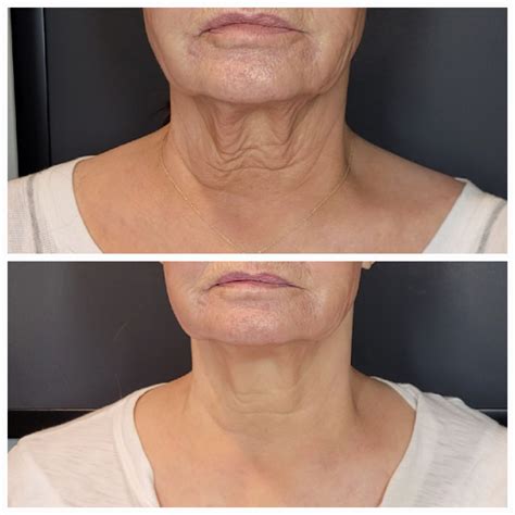 Non-Invasive Skin Tightening Treatments