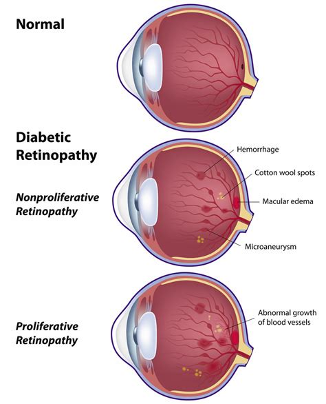 Non-Proliferative Retinopathy (NPDR)