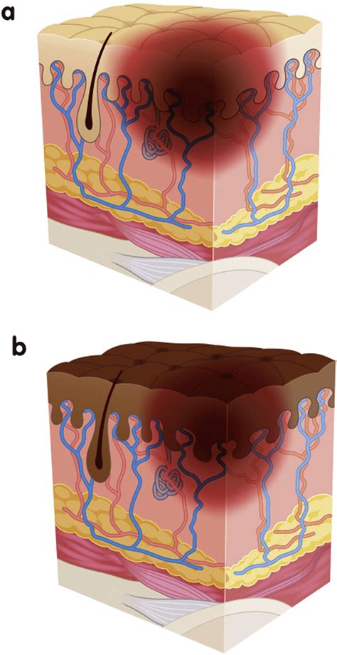Unveiling the Mystery of Nonblanchable Erythema Of Intact Skin: Understanding the Causes and Prevention Methods.