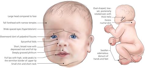 The Enigma of Noonan Syndrome Baby: Unraveling the Mysteries of this Rare Condition