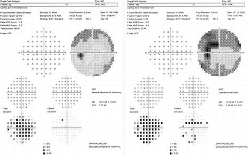Normal Pattern Standard Deviation Visual Field