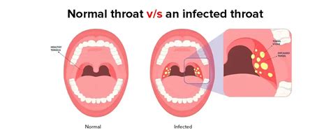 Normal Throat vs Strep Throat: A Detailed Comparison
