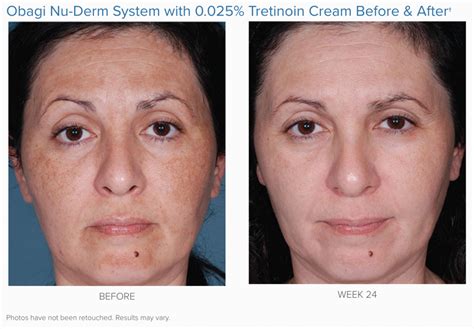 Unlock the Secret to Radiant Skin with Nu Skin Before and After Transformations