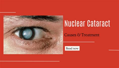 Nuclear Cataracts: Causes & Effective Treatments