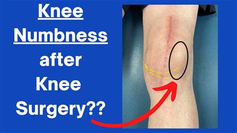 The Peculiar Phenomenon of Post-Surgical Numbness: Decoding the Mystery Behind Numb Skin After Surgery