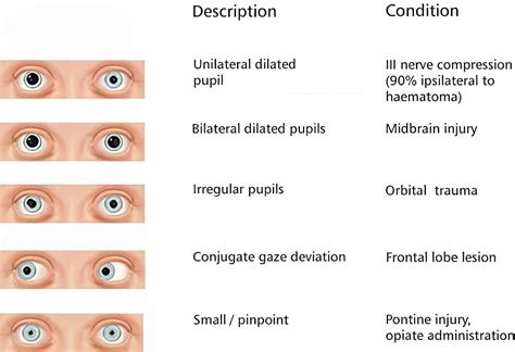 Nursing Pupil Dilation Chart