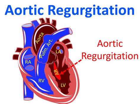 Nutrition and Diet Aortic Regurgitation