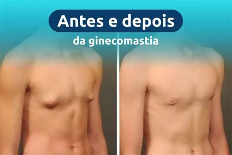 Cirurgia de Ginecomastia - YouTube