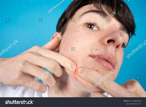 OMG! Teen in Critical Condition After Exploding Pimple Infection