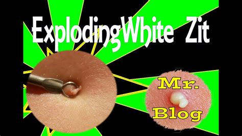 OMG! Zit Apocalypse: Watch an Exploding Pimple Send Blood Flying