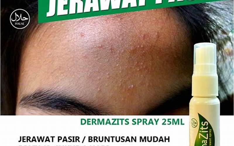 Obat Jerawat Pasir, Solusi Mengatasi Jerawat Pasir