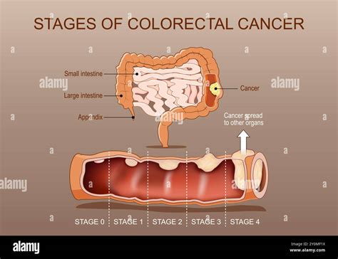 Of Colon Cancer
