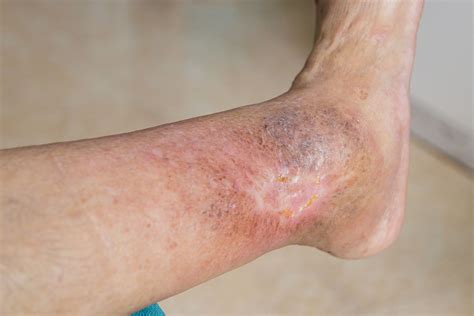Offenes Bein Anfangsstadium Bilder