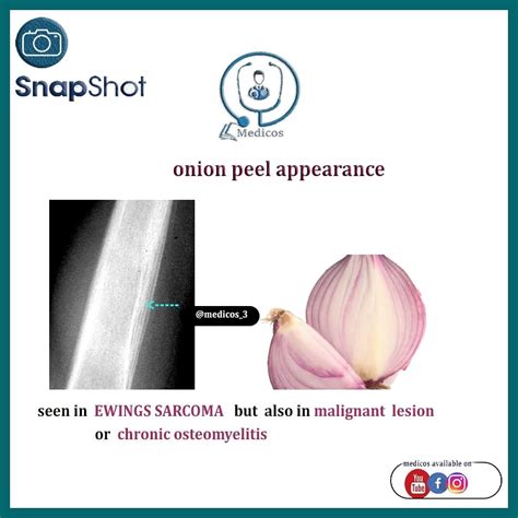 Peeling Layers of Hope: Breakthroughs in the Fight Against Ewing Sarcoma Revealed by Onion Skinning Technique