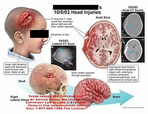 Open Head Injuries image