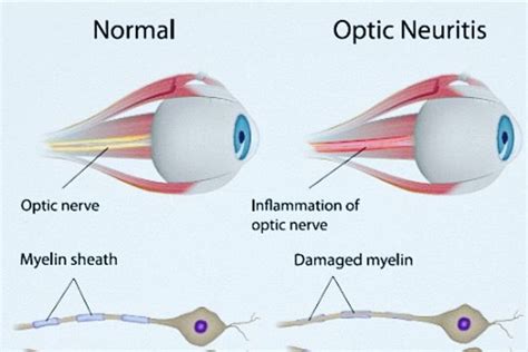 Optic Neuritis: The Most Common Culprit