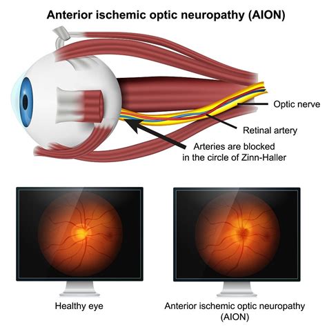 Optic Neuropathy and Movement Issues