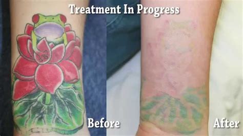 Laser Tattoo Removal Orange County Before/After YouTube