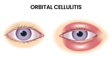Orbital Cellulitis and Abscesses