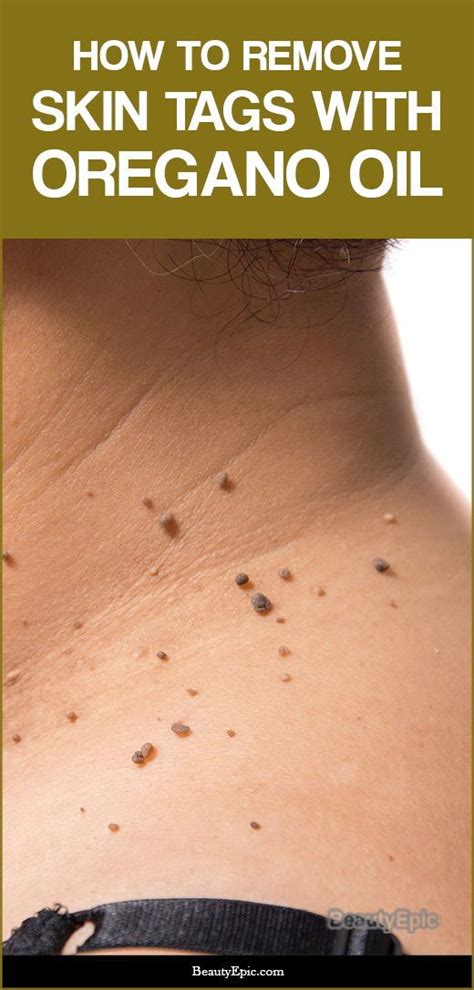 Say Goodbye to Embarrassing Skin Tags Forever with the Amazing Healing Benefits of Oregano Oil