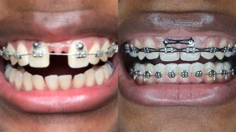 Orthodontic Options for Fixed Gaps