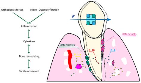 Orthodontic Tooth Movement and Irritation