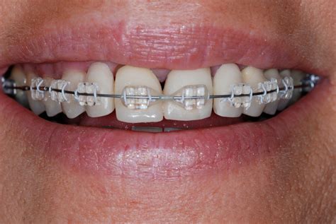 Orthodontic procedures for front teeth correction