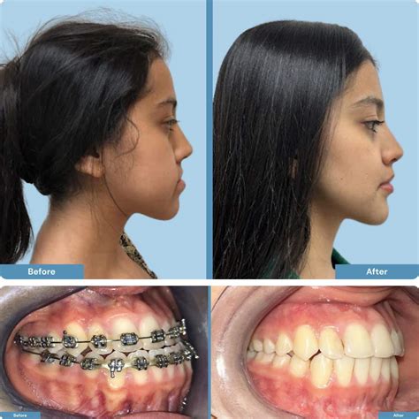 Orthognathic surgery