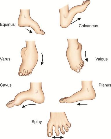 Orthopedic Deformities