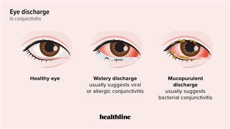 Other Causes of Eye Discharge