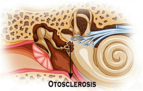 Otosclerosis causes, symptoms, diagnosis and otosclerosis treatment