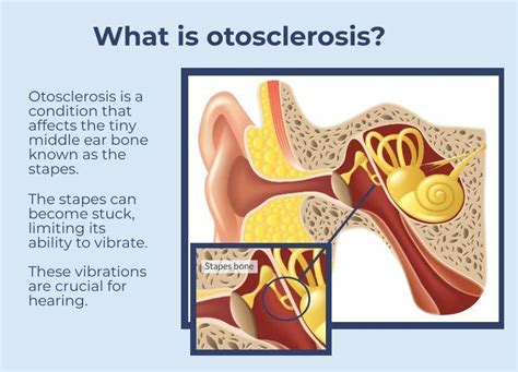 Otosclerosis causes, symptoms, diagnosis and otosclerosis treatment