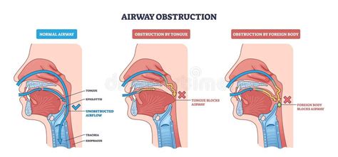 Overpacking and Airflow Blockage