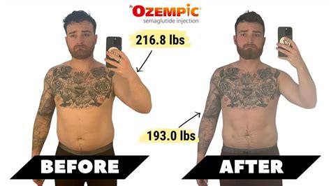 Ozempic Before And After In 5 Weeks