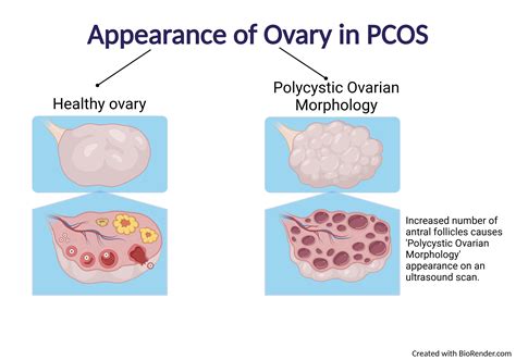 PCOS Can Be Managed