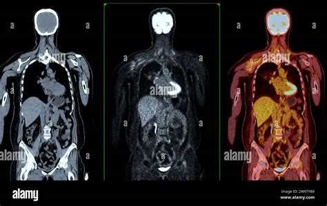 PET Scans: Metabolic Activity