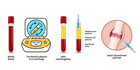 PRP Therapy in Chicago - Understanding the Process