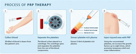 PRP therapy