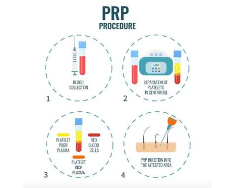 PRP therapy procedure