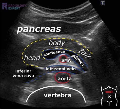 Ultrasound of the pancreas what normal looks like