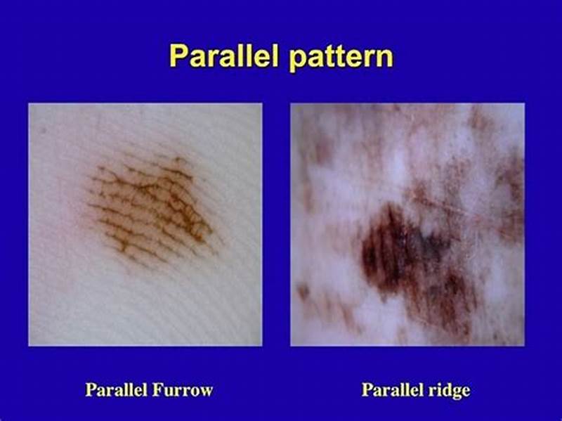 Parallel Furrow Pattern