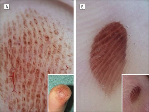 Parallel Ridge Pattern