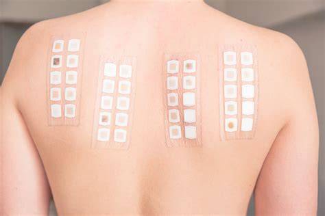 Patch Test: A Must-Do
