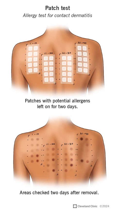 Patch Testing for Sensitive Skin