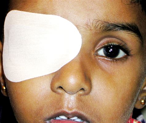 Patching Therapy: The Tried-and-True Method